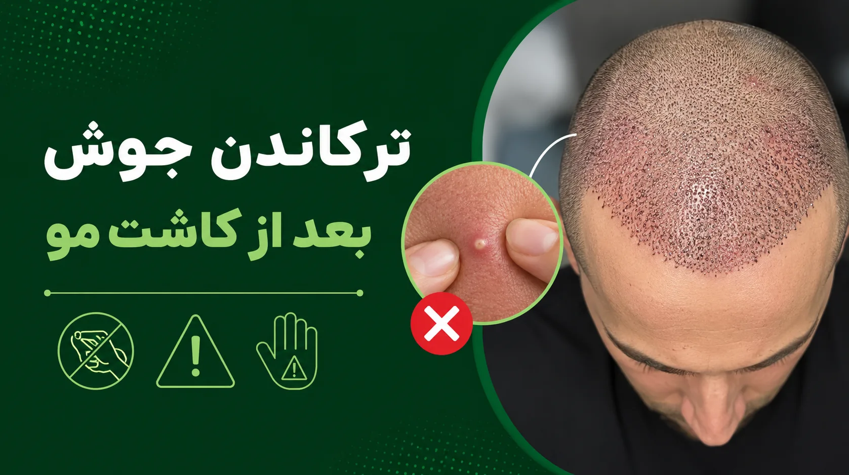ترکاندن جوش بعد از کاشت مو